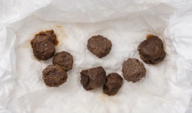 Stool sample 1