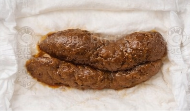 Stool sample 2