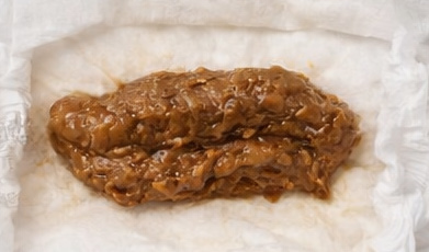Stool sample 3