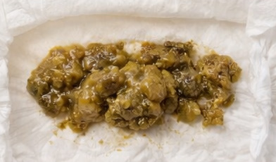 Stool sample 7